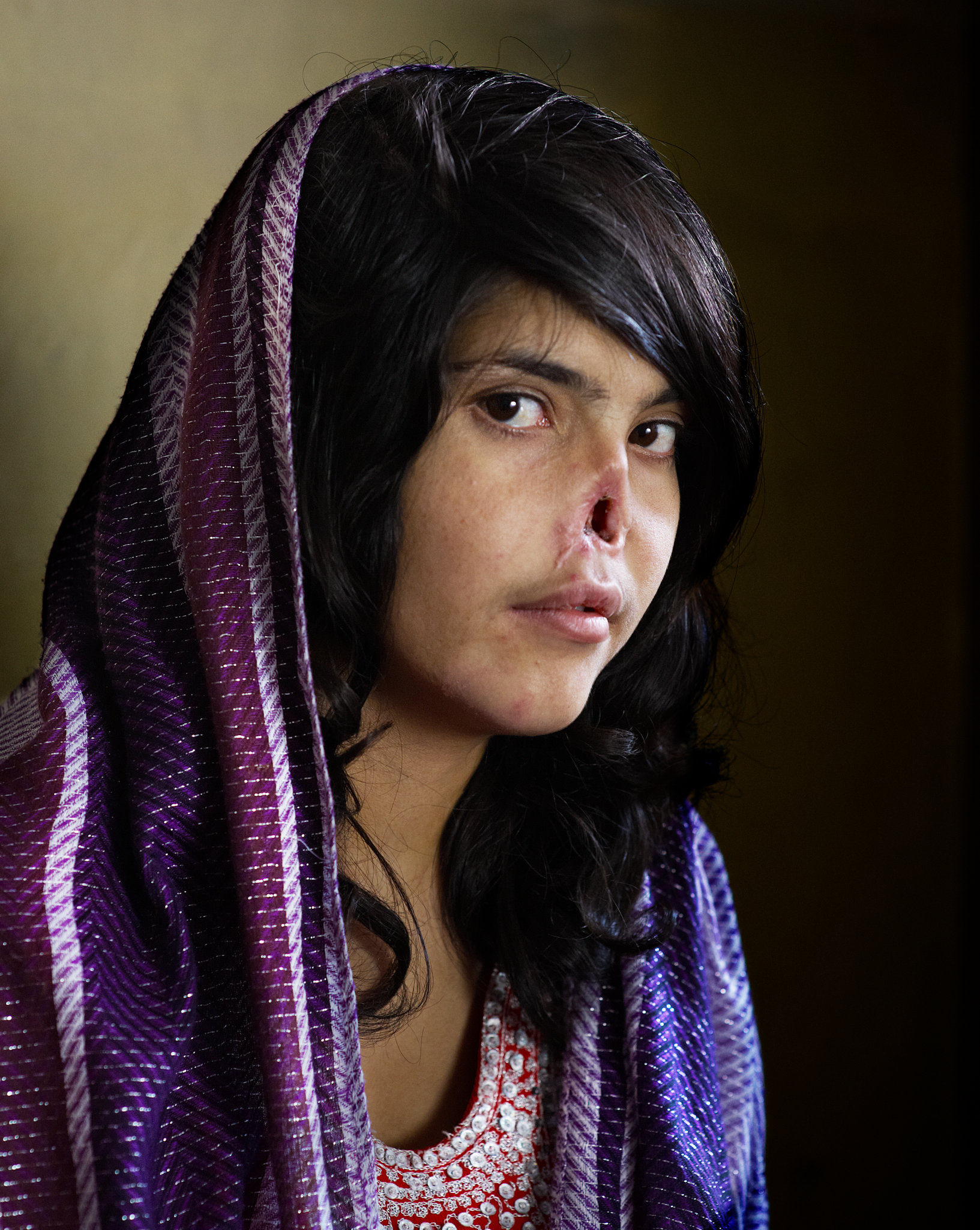 Bibi Aisha 18χρονη Αφγανή