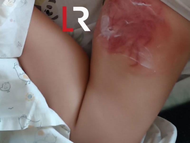  Φθιώτιδα: Θαλάσσια ανεμώνη τσίμπησε 4χρονη – Με σοβαρά εγκαύματα το παιδί 