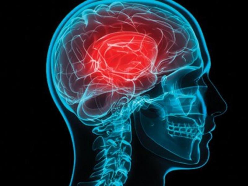 Εγκεφαλικό: Τα 5 προειδοποιητικά σημάδια που πρέπει να γνωρίζουμε